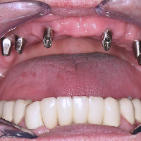  The seated screw-retained abutments to hold  the prosthesis