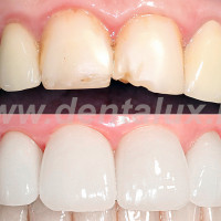 Dent-A-Lux Fogászat, fogorvos, fogbeültetés, fogimplantátum, Kecskemét, Straumann fogpótlás