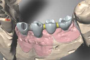 Mint kecskemét-i fogorvos, a Dent-A-Lux fogászat vezetője nagyon örülök, hogy a fogbeültetés specialista svájci #1 fogimplantátum gyártó Straumann BLX-re Magyarországon először mi teljesen digitálisan tervezett és kivitelezett csavarozott fix fogpótlás-t. Fogorvos Kecskemét::Fogászat-Fogbeültetés-Csontpótlás-Kecskemét
