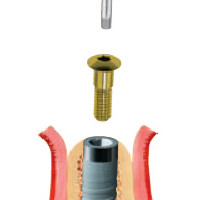 Seating the implant