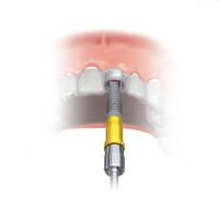  Seating the implant