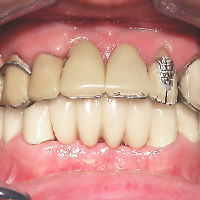  Before treatment in upper jaw