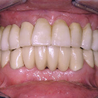  After treatment - Implants supported Zirconia non-removable prosthesis in upper jaw