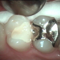  Az inlay elkészültéig ideiglenes tömés védi a fogat