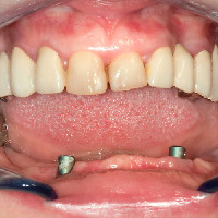  Almost toothless lower jaw with two implants