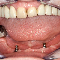  The seated ball abutments to hold the denture