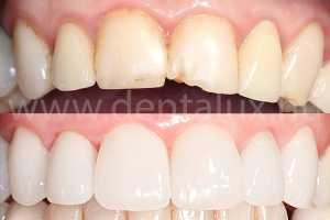 Legyen az fogászat vagy fogorvos bárhol a világon, a páciens megelégedettsége nagyon fontos. Ez nálunk Kecskeméten, a Dent-A-Lux fogszakorvosi rendelőben sincs másképp. Ennek a bemutatására úgy gondoltuk a legjobb, ha megosztunk néhány esetünket. Az első ezek közül egy mosolytervezés: fogbeültetés és fogászati implantátum alkalmazása nélkül, csupán fogpótlás, korona és foghéj készítésére alkalmas üvegkerámia felhasználásával. Mosolyátalakítás a javából!