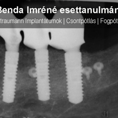 Dent-A-Lux - Implantátum Esettanulmány