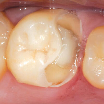 Dent-A-Lux - TUDTA-E? Amit a fogorvosok nagy része sem biztos, hogy tud…