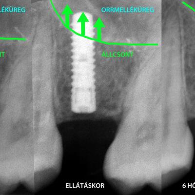 Dent-A-Lux - Csontpótlás csont/csontpótló nélkül
