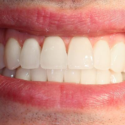 Dent-A-Lux - Mosolytervezés / -átalakítás