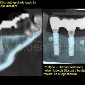 Fogimplantátum behelyezése és csontpótlás egyszerre? Igen! Az általunk alkalmazott módszerrel a fogbeültetés olyan kiterjedt csonthiány pótlásával egyidőben is elvégezhető, ami más eljárásokkal nem lenne lehetséges. Sőt! Akár a foghúzás után azonnal. Csontpótlás és fogbeültetés (fogászati implantáció): egyszerre!
