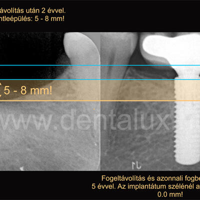 Dent-A-Lux - Fogbeültetés azonnal (1.) - amit tudni érdemes