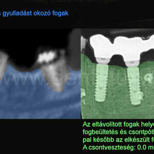 Itt az utolsó, 3. rész. Fogbeültetés (és csontpótlás) azonnal a fogeltávolítás után. Amit tudni érdemes. A ma legmodernebbnek számító kezeléseket ismertetjük, amiket az ilyen esetekben nemcsak a berni egyetemi klinikán, de már nálunk a Dent-A-Lux fogászaton, fogorvosi rendelőben, Kecskeméten is alkalmazunk.