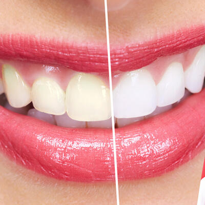 Dent-A-Lux - FOGFEHÉRÍTÉS: mikor, mivel, hogyan?