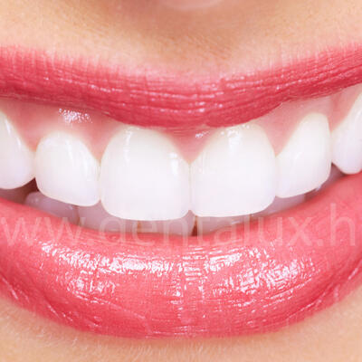 Dent-A-Lux - Mennyibe kerül? -1. rész