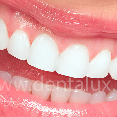 Dent-A-Lux - Mennyibe kerül? -2. rész