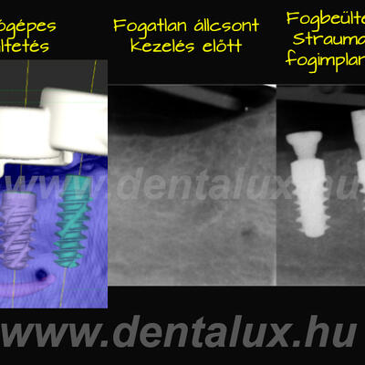 Dent-A-Lux - Foghúzás után fogbeültetés és fogpótlás azonnal! Straumann BLX  guide