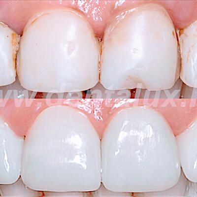 Dent-A-Lux - Az eddigi legjobbunk!