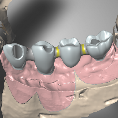 Dent-A-Lux - Fogpótlás a jövőből, Magyarországon nálunk először!