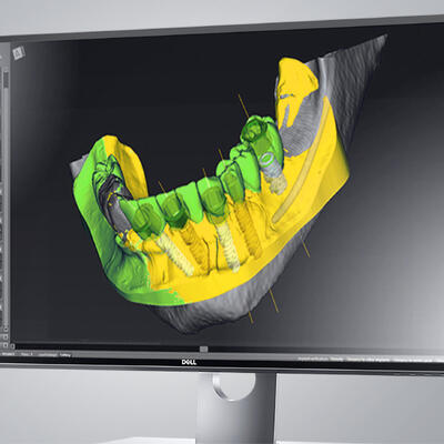 Dent-A-Lux - MŰTÉT NÉLKÜLI IMPLANTÁCIÓ. Előnyök, hátrányok.
