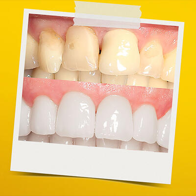 Dent-A-Lux - Modern fogpótlások