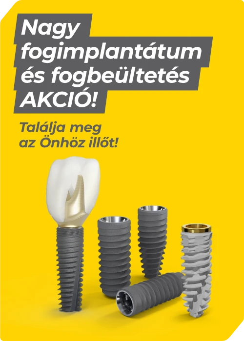 Fogimplantátum és fogbeültetés akció a kecskeméti Dentalux Fogászaton