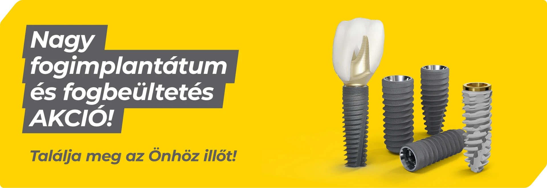 Fogimplantátum és fogbeültetés akció a kecskeméti Dentalux Fogászaton