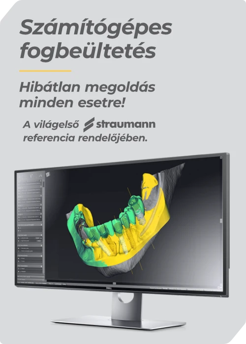 Számítógépes fogbeültetés a Straumann referencia rendelőjében, a Dentalux Fogászaton