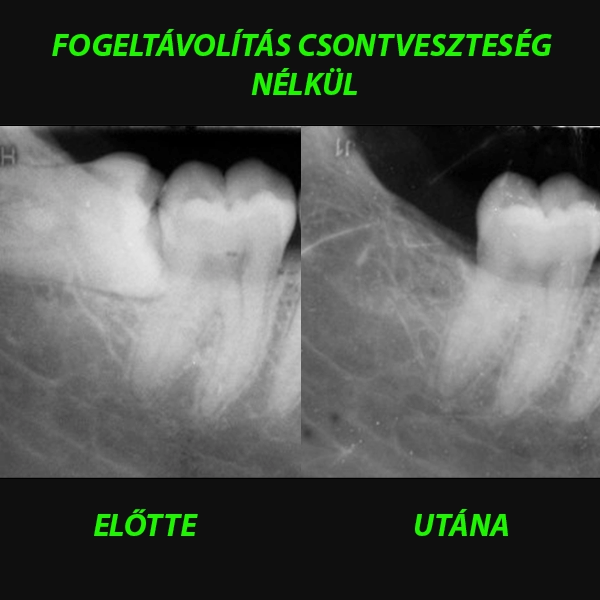 Fogelt&aacute;vol&iacute;t&aacute;s csontvesztes&eacute;g n&eacute;lk&uuml;l: az &aacute;llcsontprezerv&aacute;ci&oacute; l&aacute;tv&aacute;nyos eredm&eacute;nye