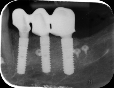 Benda Imréné gyógyult Straumann fogimplantátumai és csontpótlása a kecskeméti Dentalux Fogászaton (Röntgenfelvétel)
