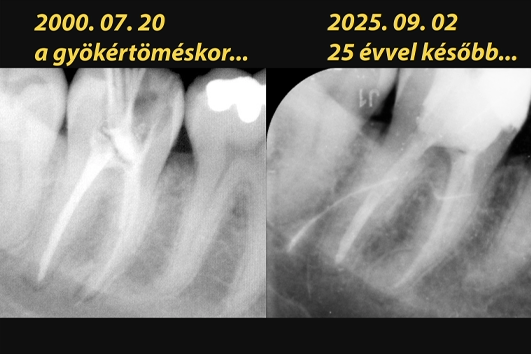 &Ouml;sszehasonl&iacute;t&oacute; r&ouml;ntgenfelv&eacute;tel: 2000-es gyulladt &aacute;llapot vs. 2025-&ouml;s gy&oacute;gyult &aacute;llapot