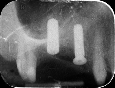 Fogimplant&aacute;tum Kecskem&eacute;t: Műt&eacute;t ut&aacute;ni r&ouml;ntgen, Straumann Roxolid implant&aacute;tum &eacute;s csontp&oacute;tl&aacute;s