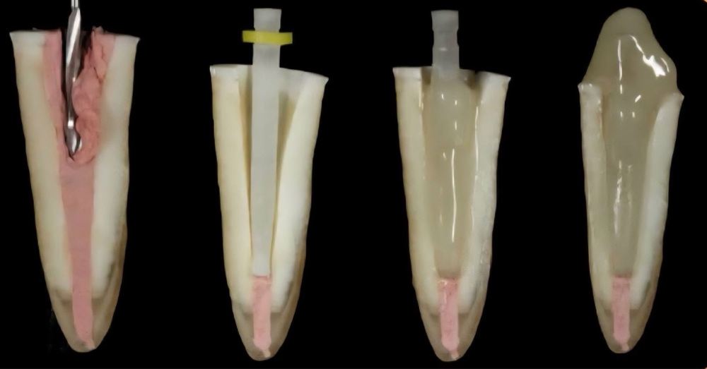 &Uuml;vegsz&aacute;las csap behelyez&eacute;se l&eacute;p&eacute;sről l&eacute;p&eacute;sre